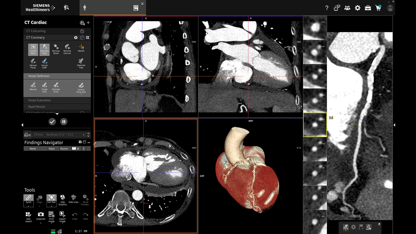 Siemens Healthineers syngo.via CT Cardiac application screenshot with 3D and sectional views, official manufacturer example